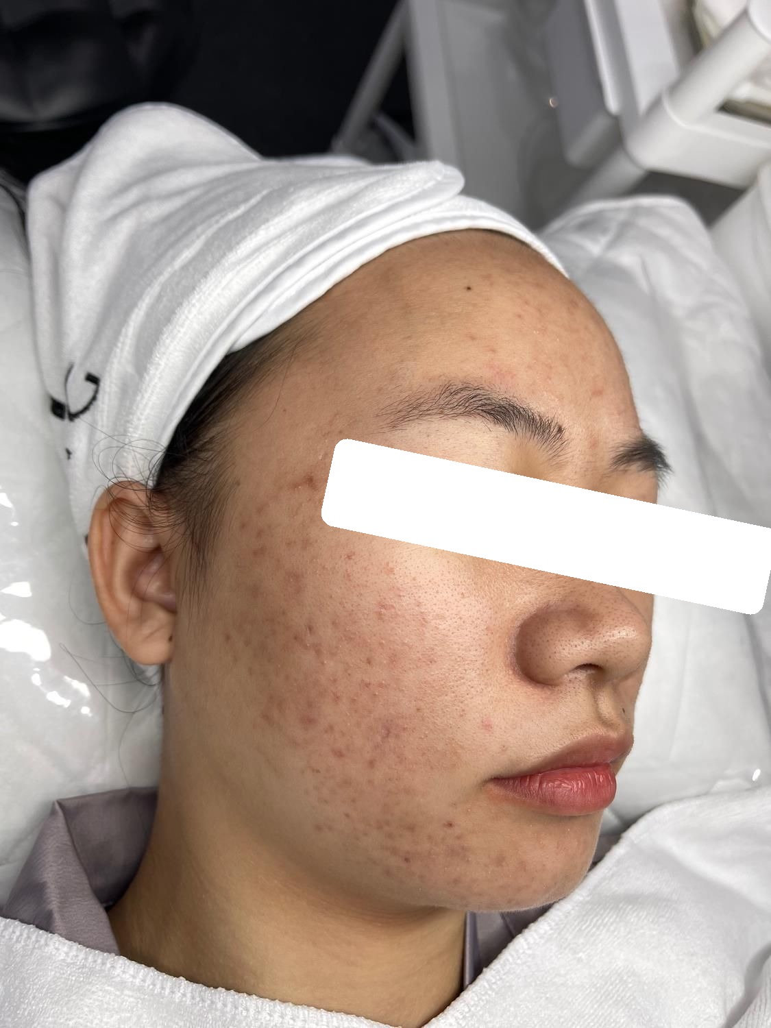 Mụn ẩn trên nền da dầu dày sừng, PIH, PIE — trước điều trị
