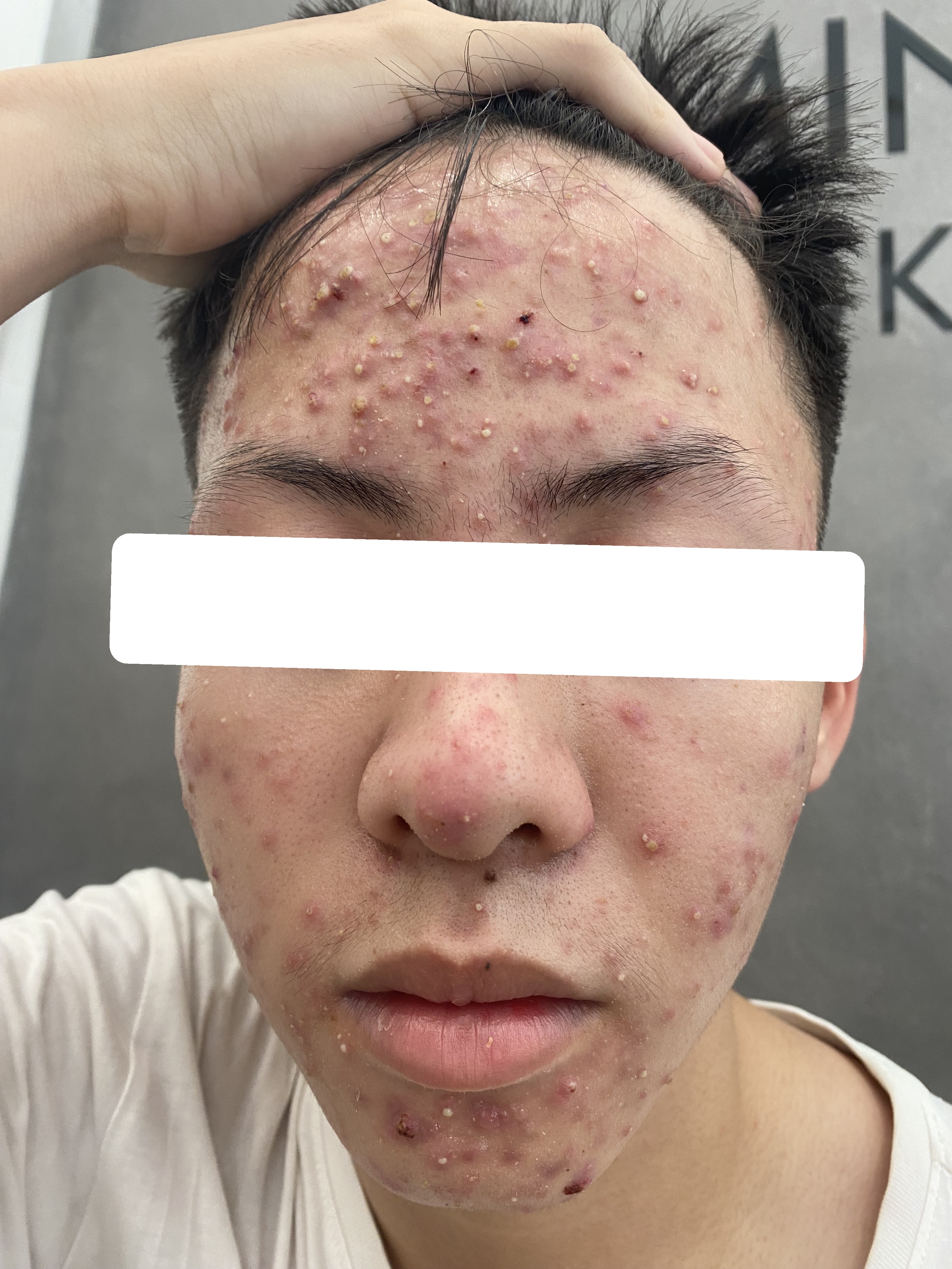 Mụn trứng cá bội nhiễm mức độ nặng — trước điều trị