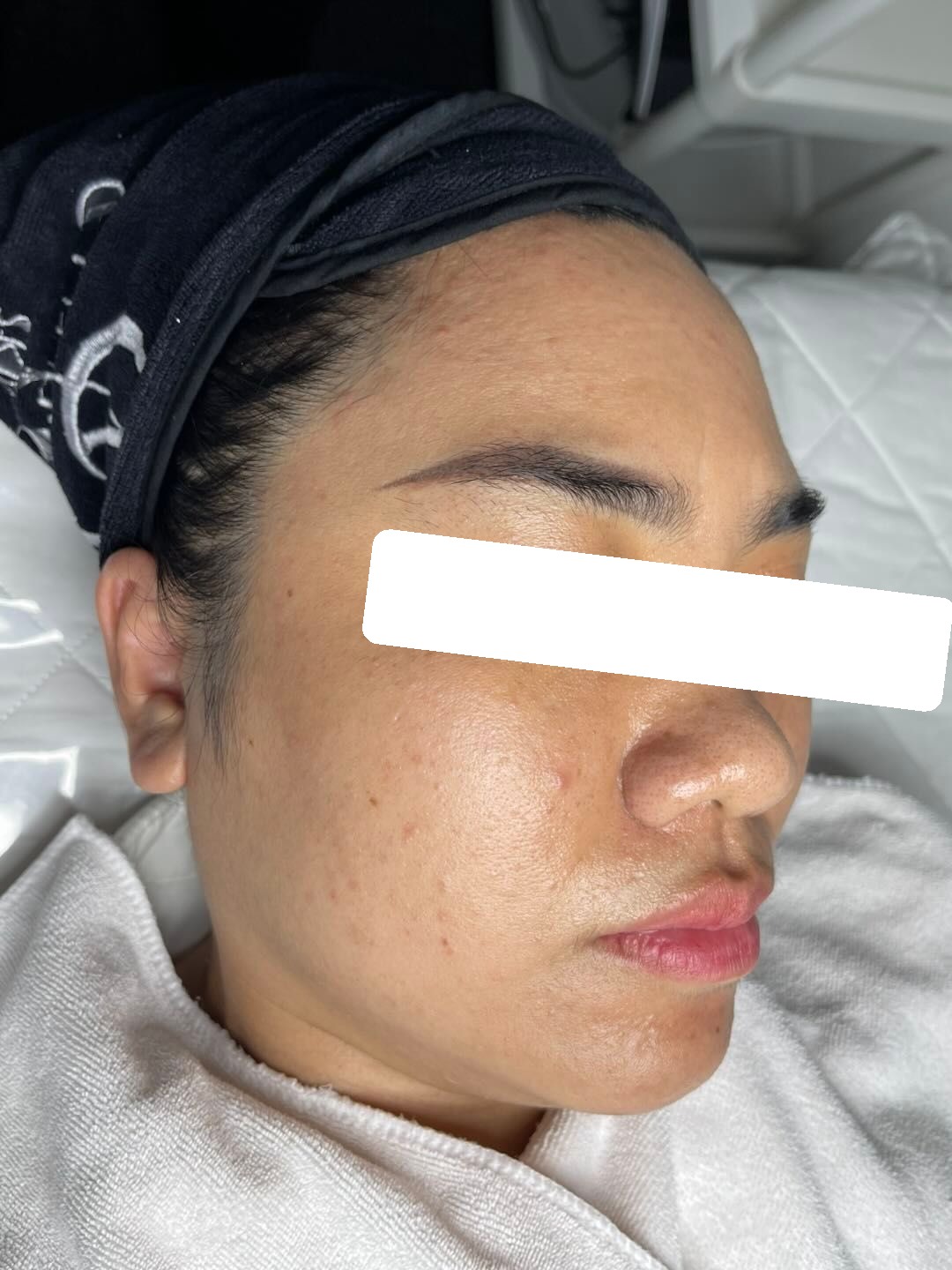 Mụn viêm nội tiết trên nền da dầy sừng, sần vỏ cam, PIH — sau điều trị