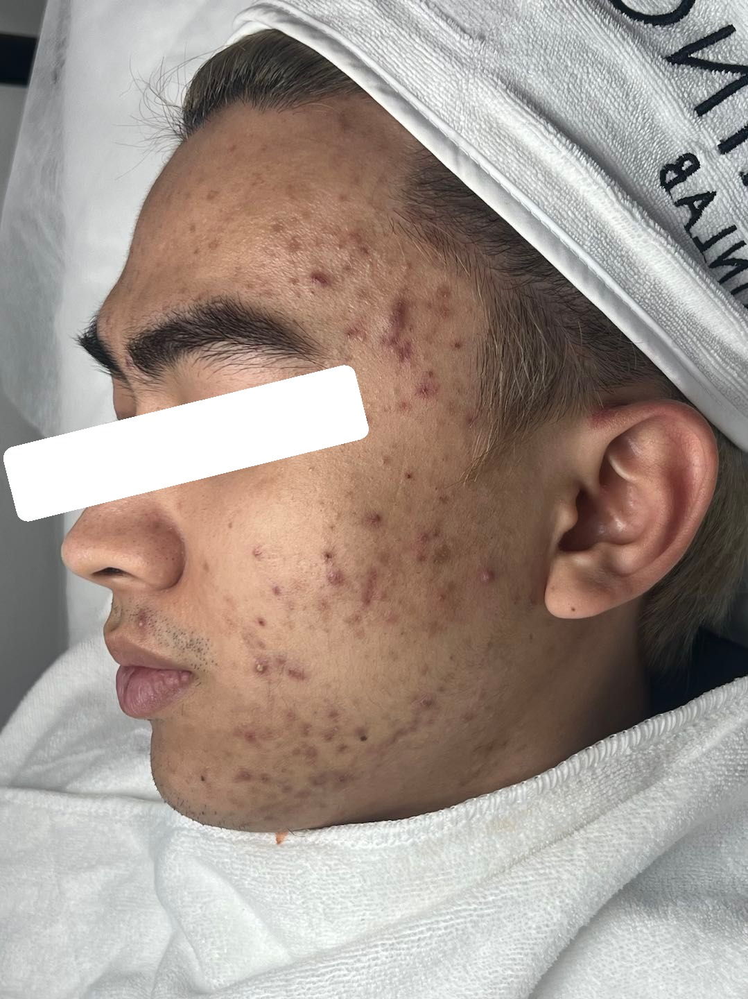 Mụn viêm, ẩn nặng, PIH, sẹo — trước điều trị
