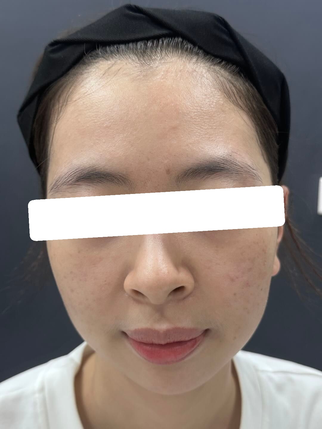 Mụn trứng cá mức độ nặng, PIIE, sẹo — sau điều trị