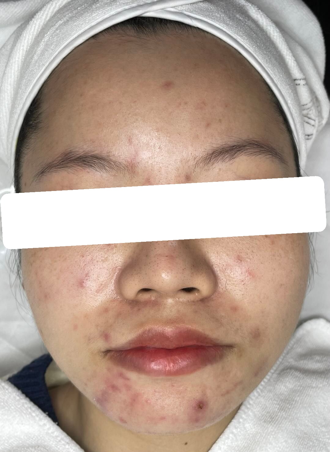 Mụn viêm nội tiết vùng cằm, PIH — trước điều trị