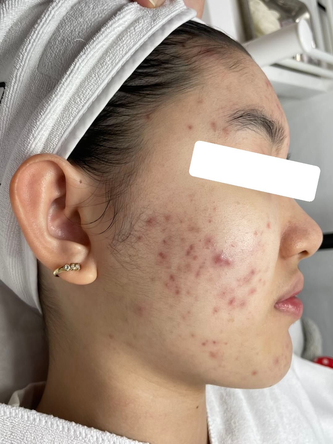 Mụn viêm nặng 2 vùng má, PIE, da nhạy cảm — trước điều trị