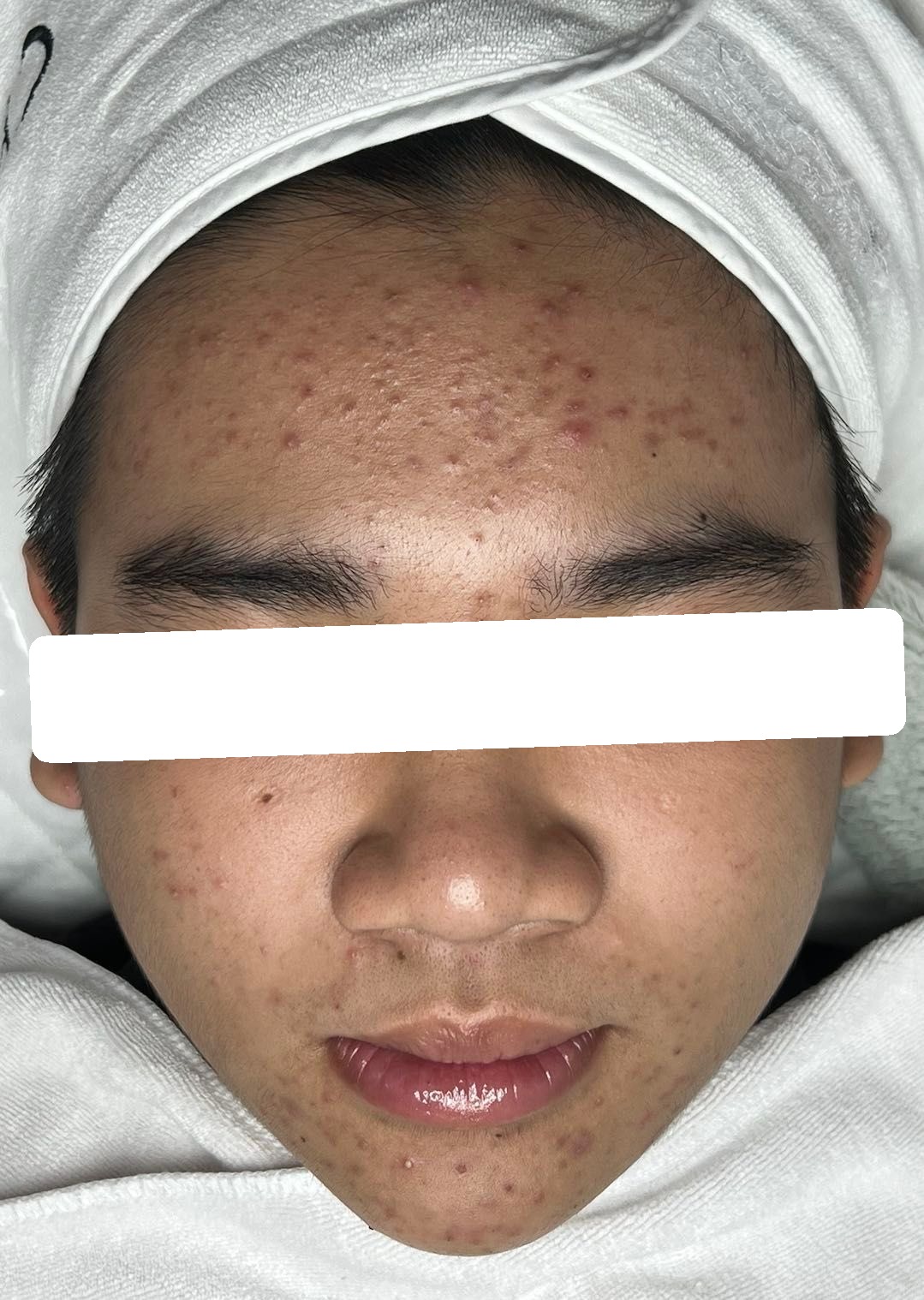 Mụn ẩn, viêm trên nền da dầu dày sừng, PIH, PIE — trước điều trị
