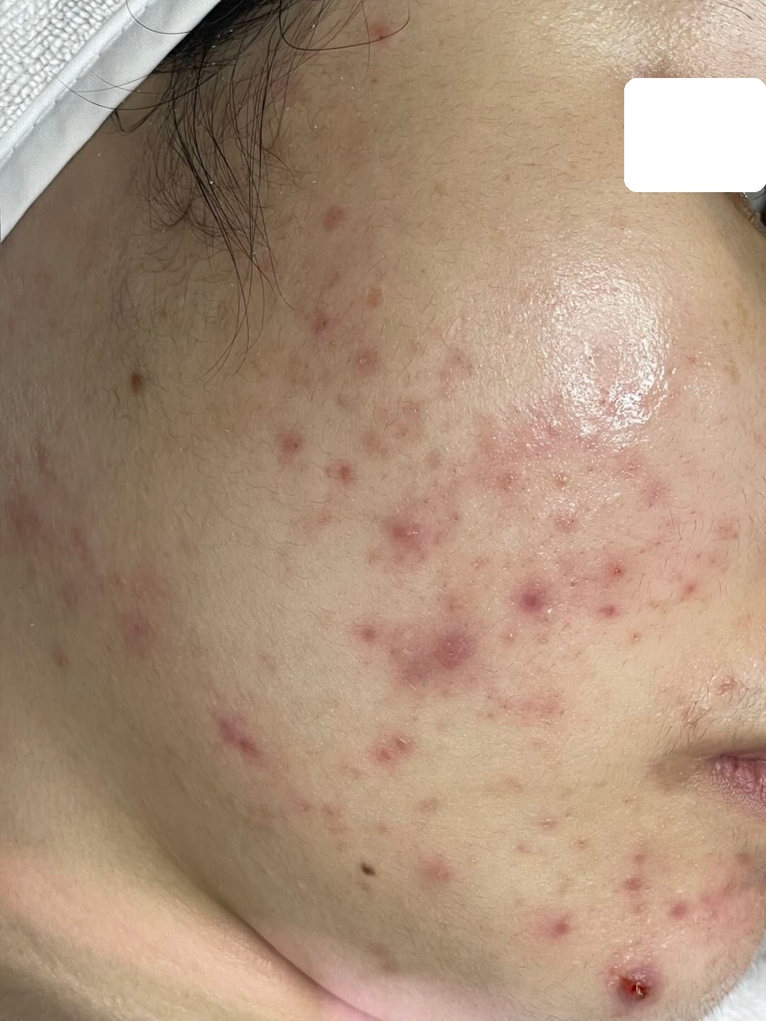 Mụn viêm nặng 2 vùng má — Trước