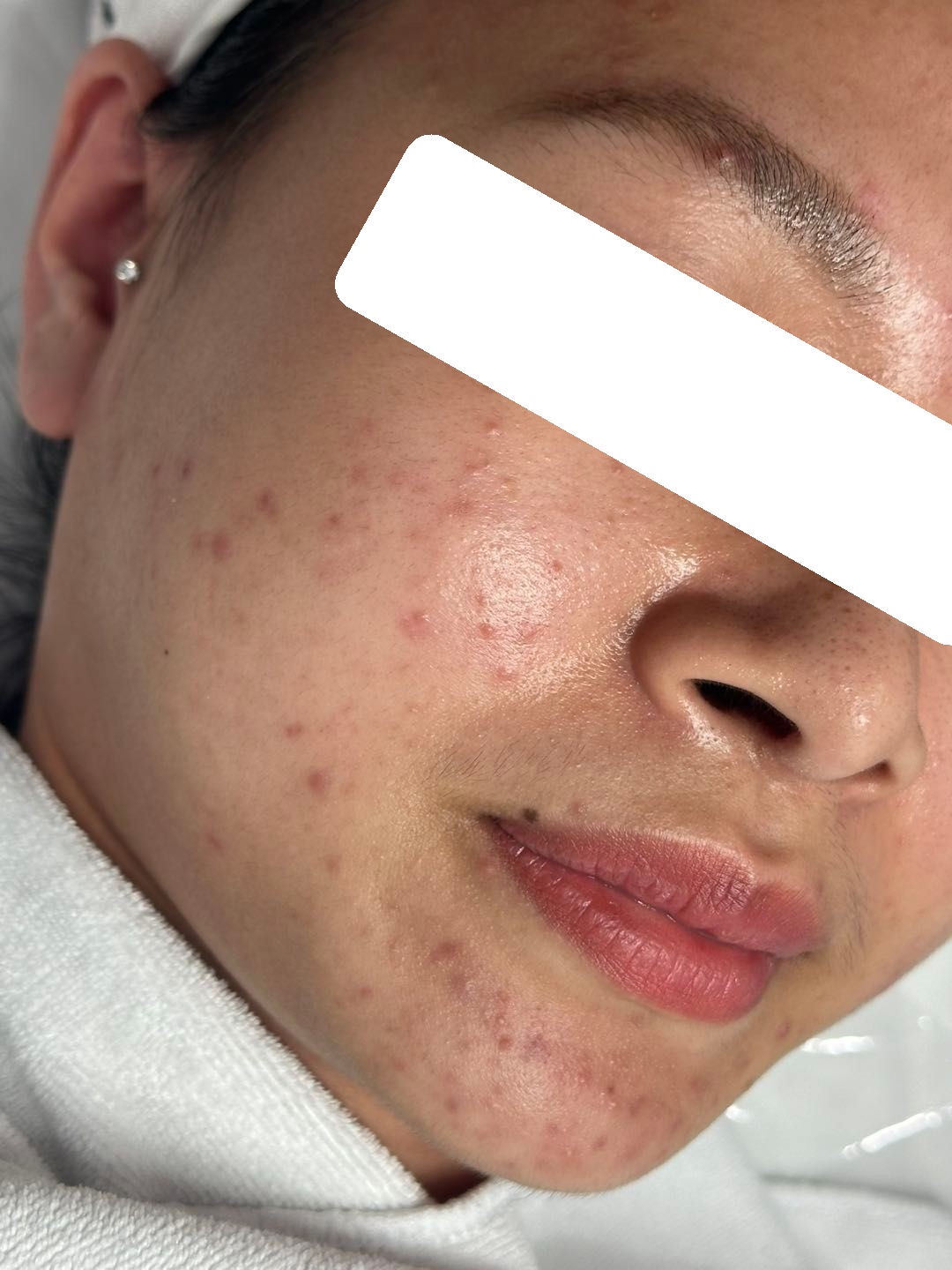 Inflamed acne, PIH — Before