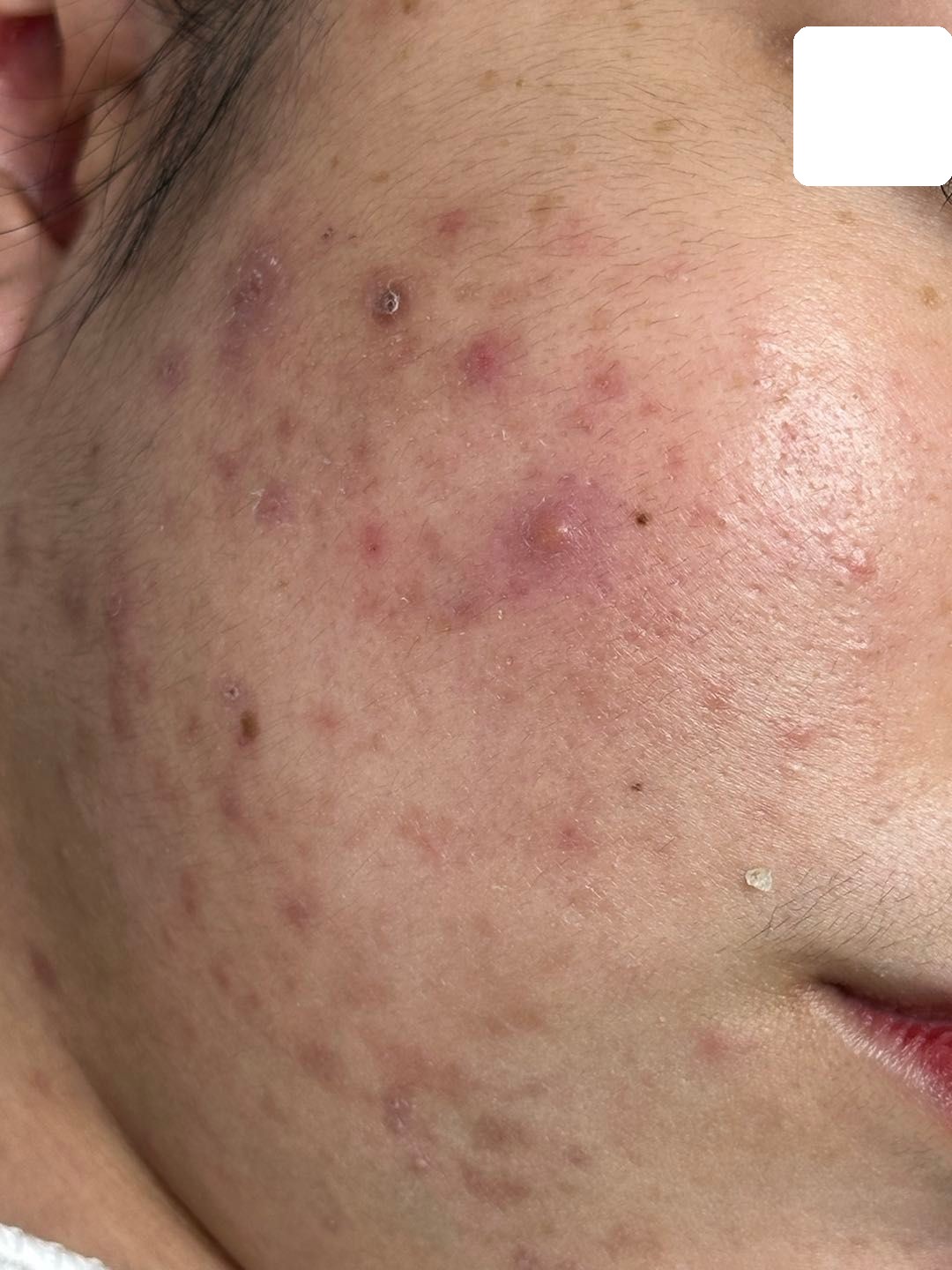 Mụn viêm, ẩn nặng, PIE — Trước