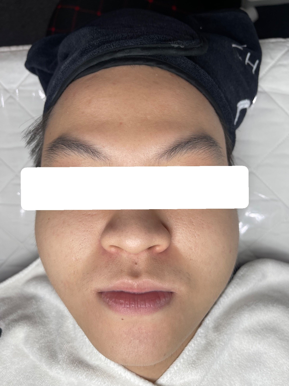 Inflamed acne, PIE — After 4 sessions