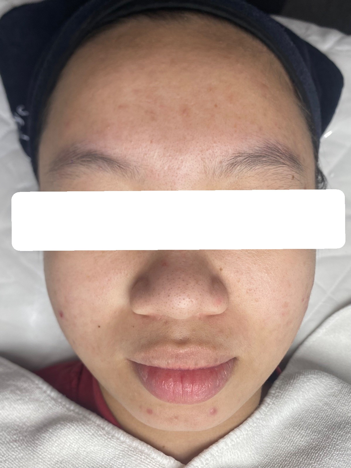 Inflamed and congested acne, PIE — After 5 sessions