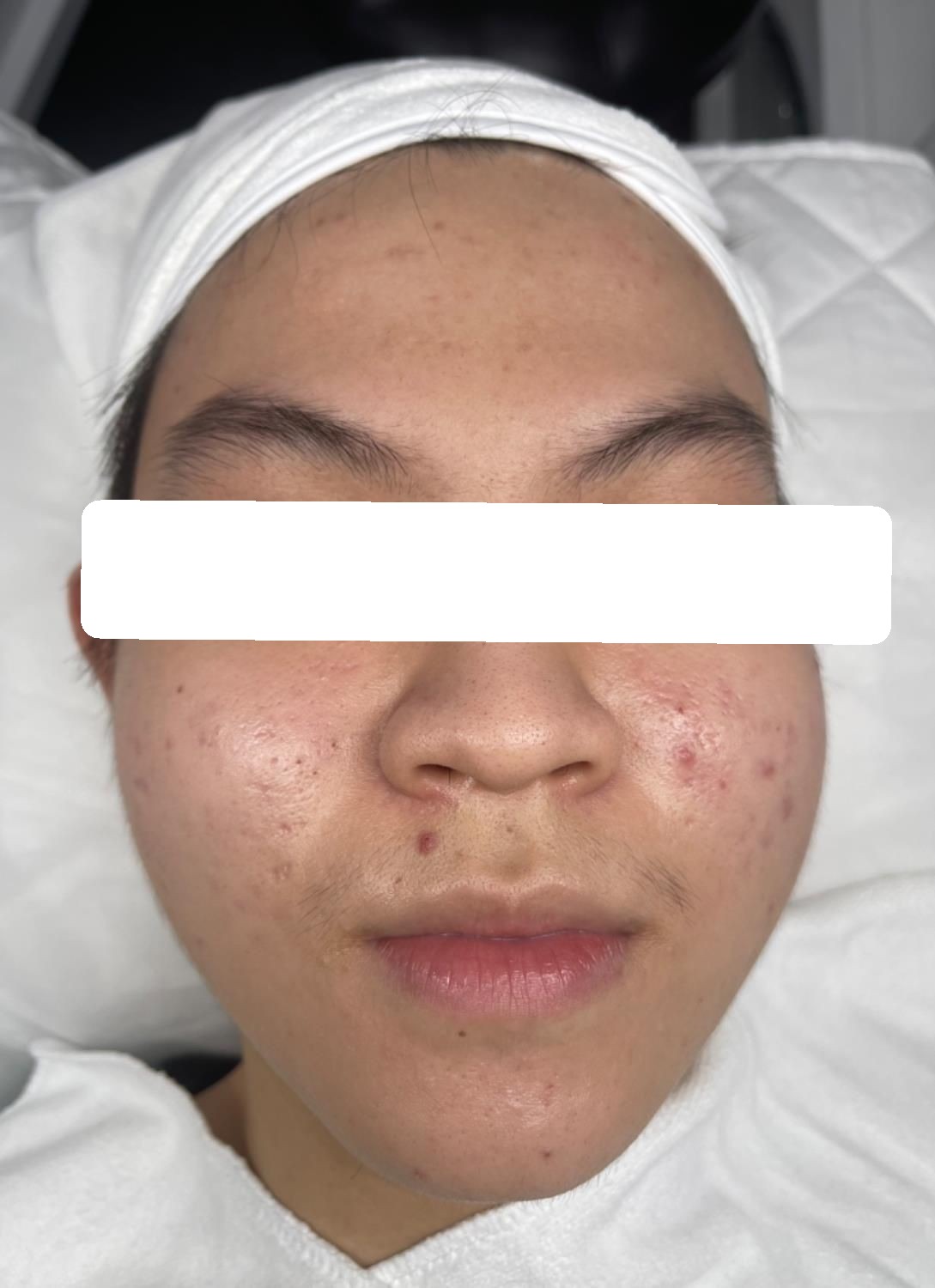 Inflamed acne, PIE — Before