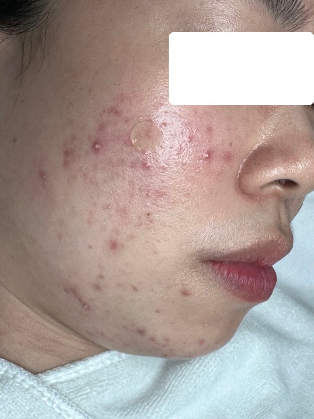 Severe inflamed acne on both cheeks — Before