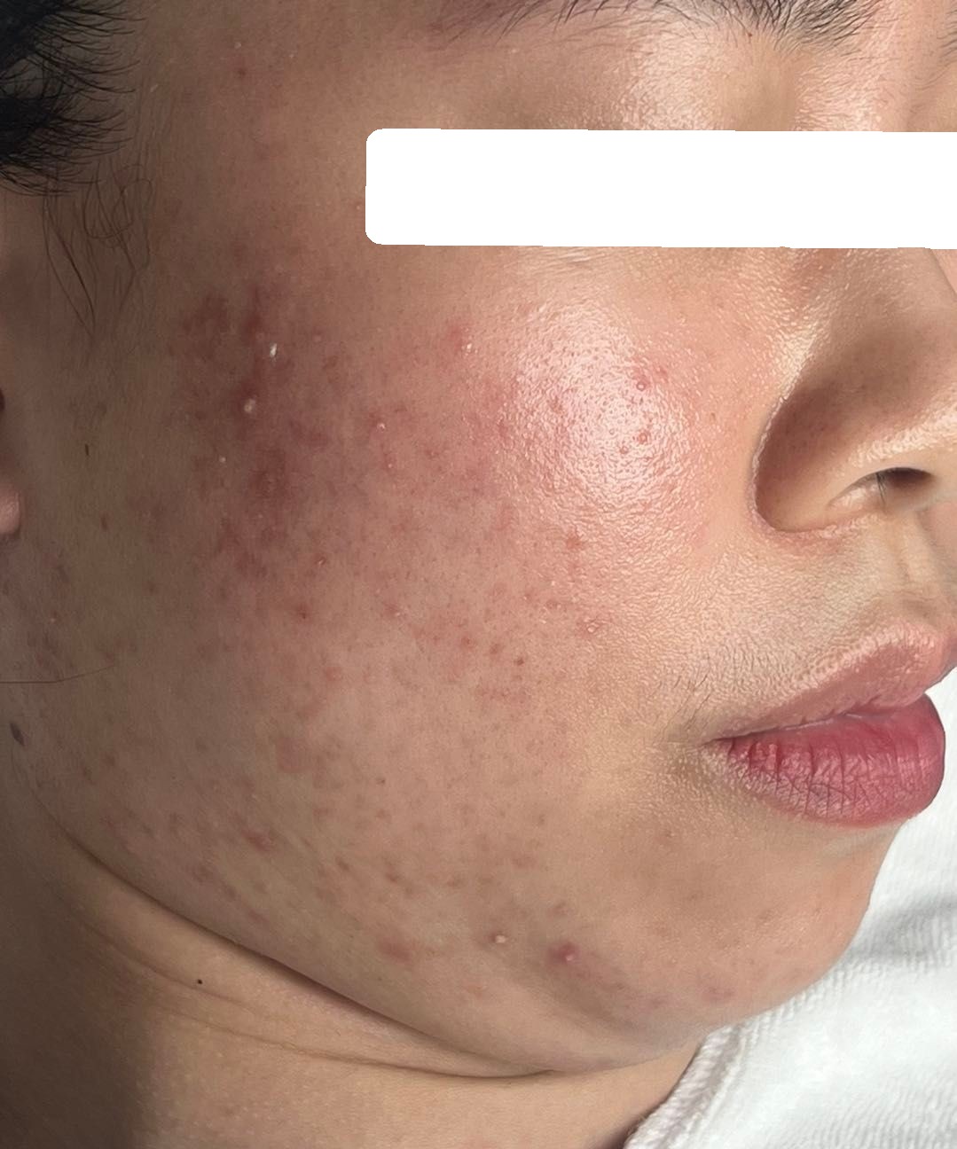 Severe inflamed acne on both cheeks — After 3 sessions