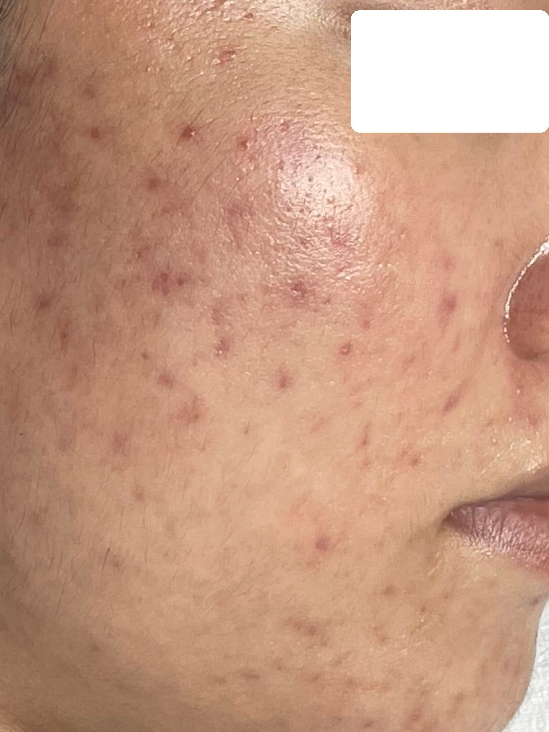 Widespread congested and inflamed acne, PIH — Before