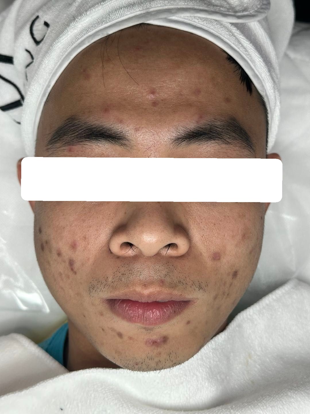 Congestion, PIH — Before