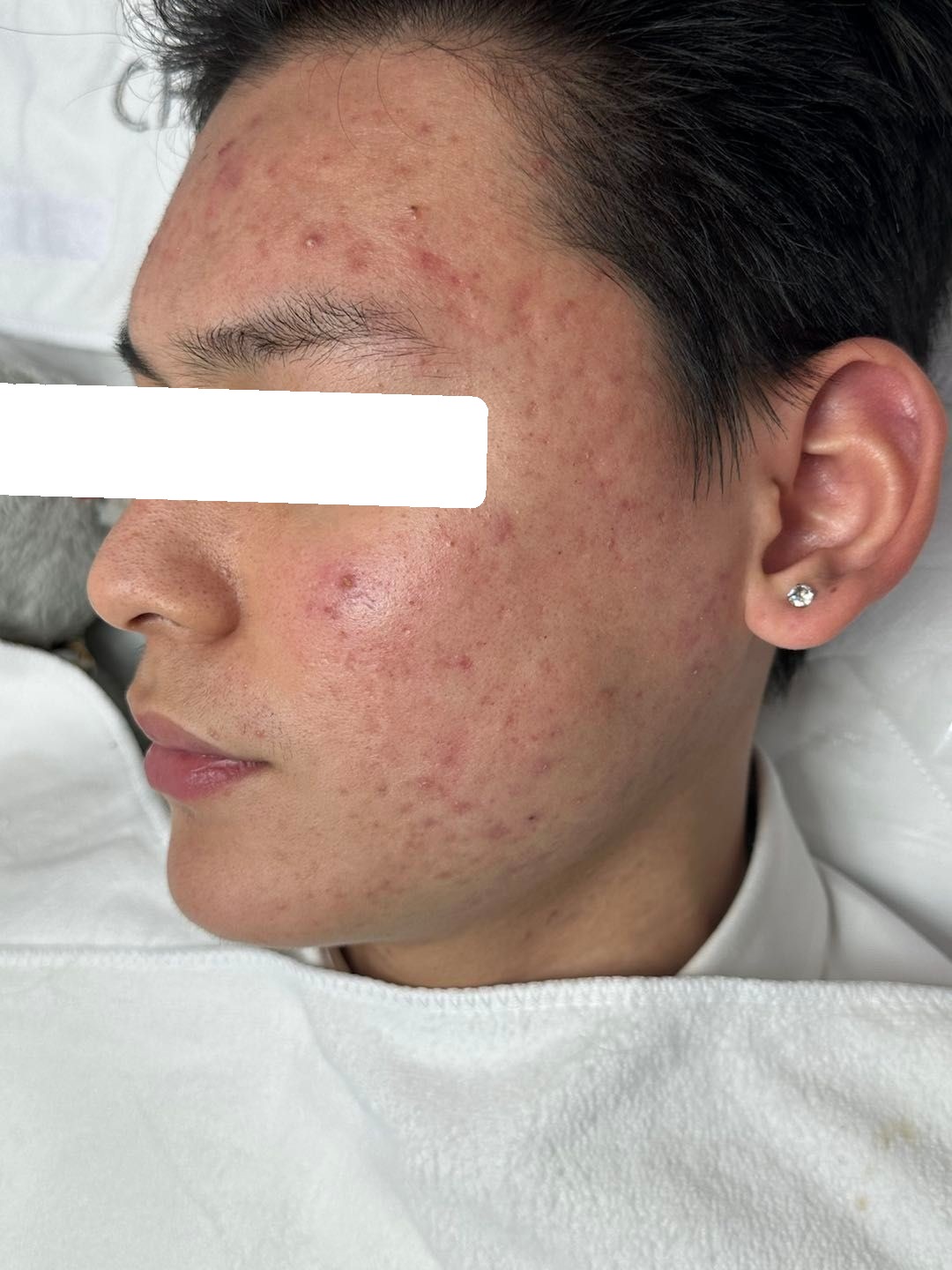 Inflamed and congested acne, PIE — Before