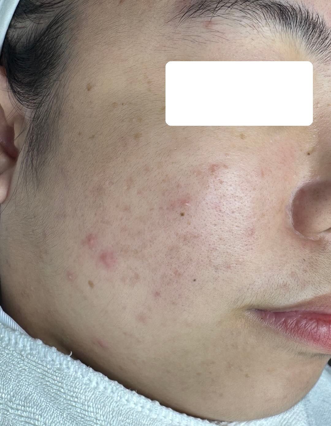 Mụn viêm, ẩn nặng, PIE — sau điều trị