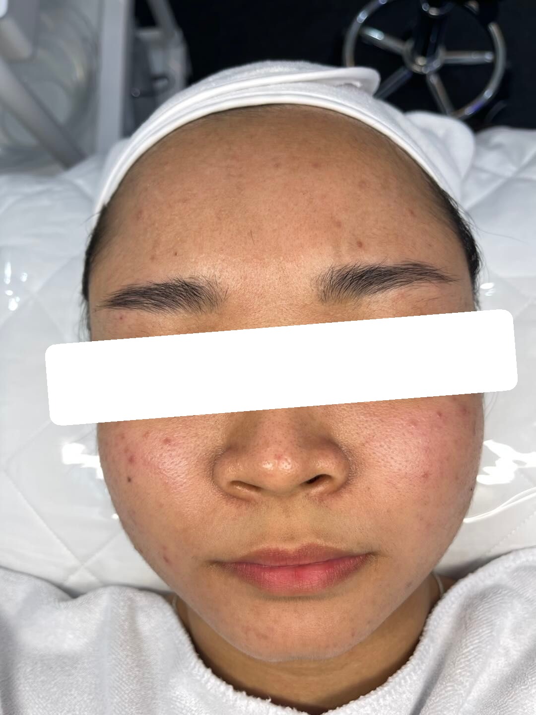 Inflamed acne, PIH — Before