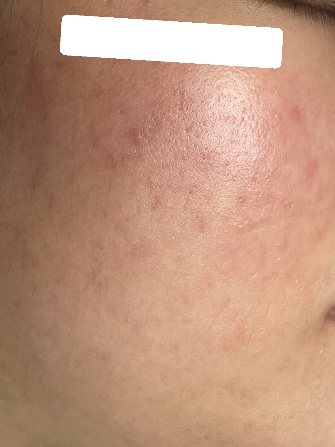 Widespread congested and inflamed acne, PIH — After 2 sessions