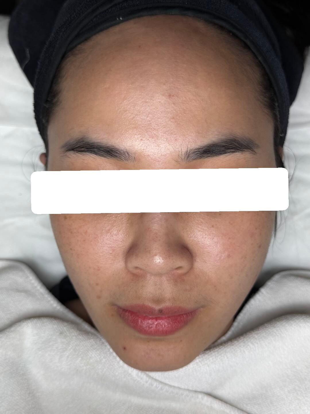 Inflamed and congested acne — After 1 session