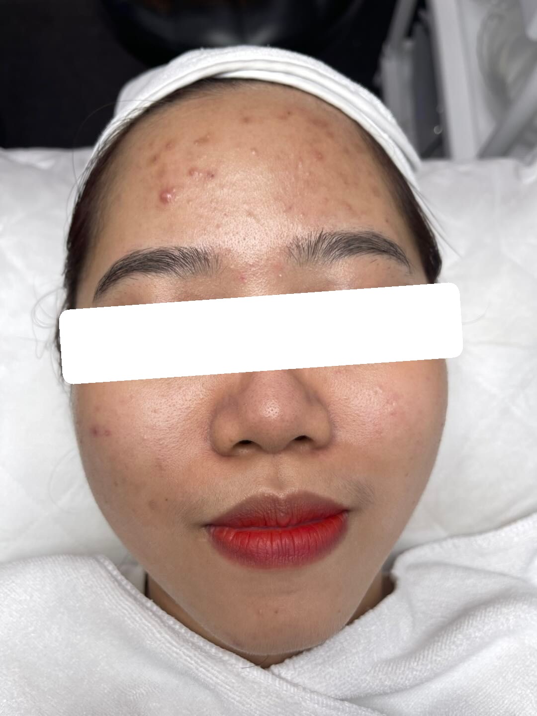 Inflamed and congested acne, PIH — Before