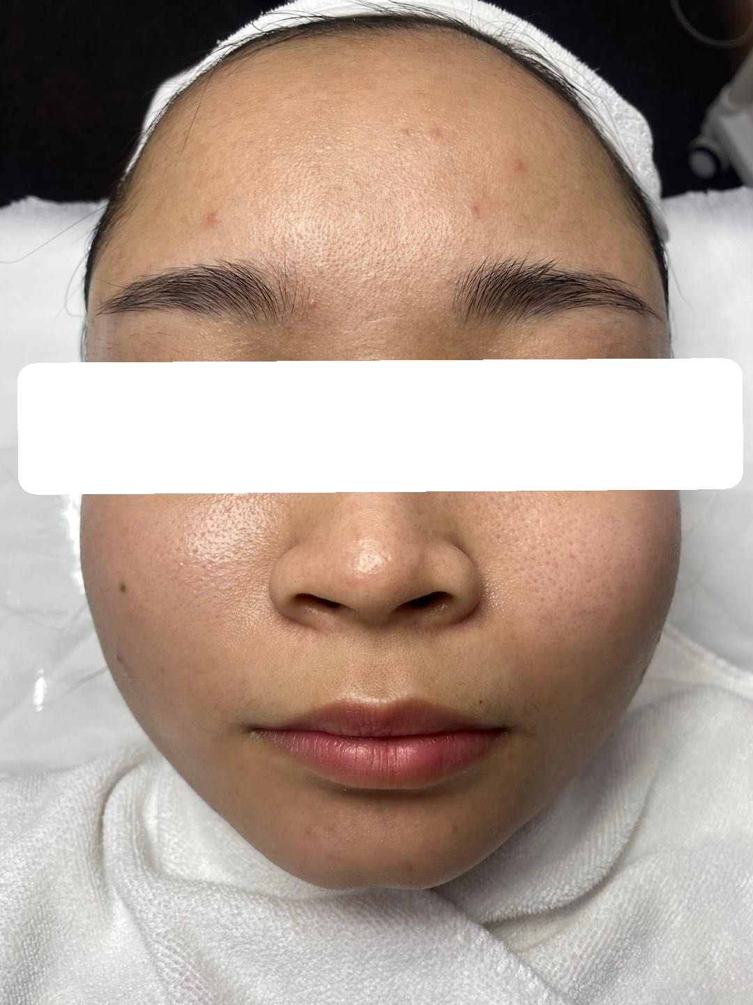 Inflamed acne, PIH — After 2 sessions