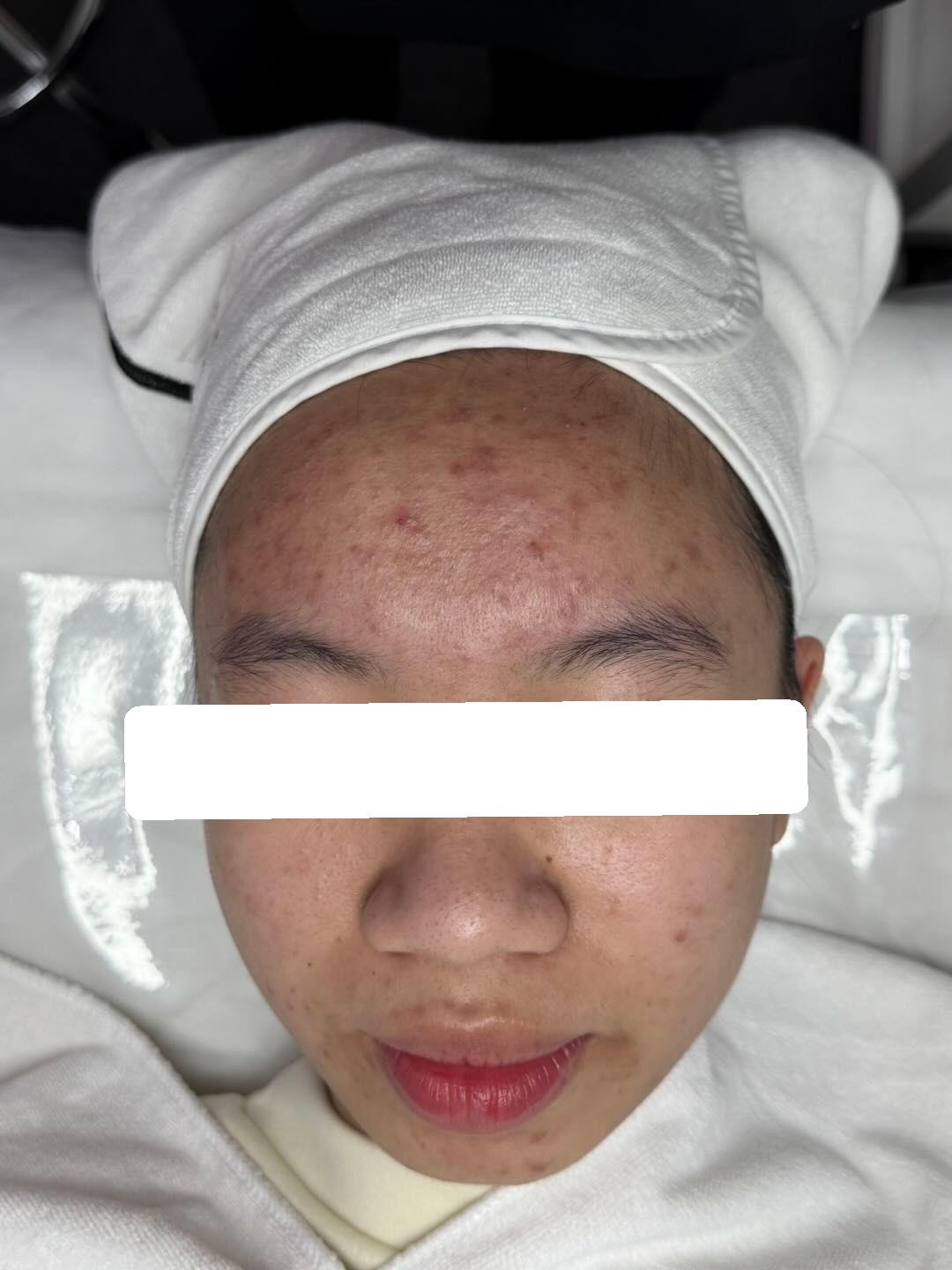 Inflamed and congested acne, PIE — Before