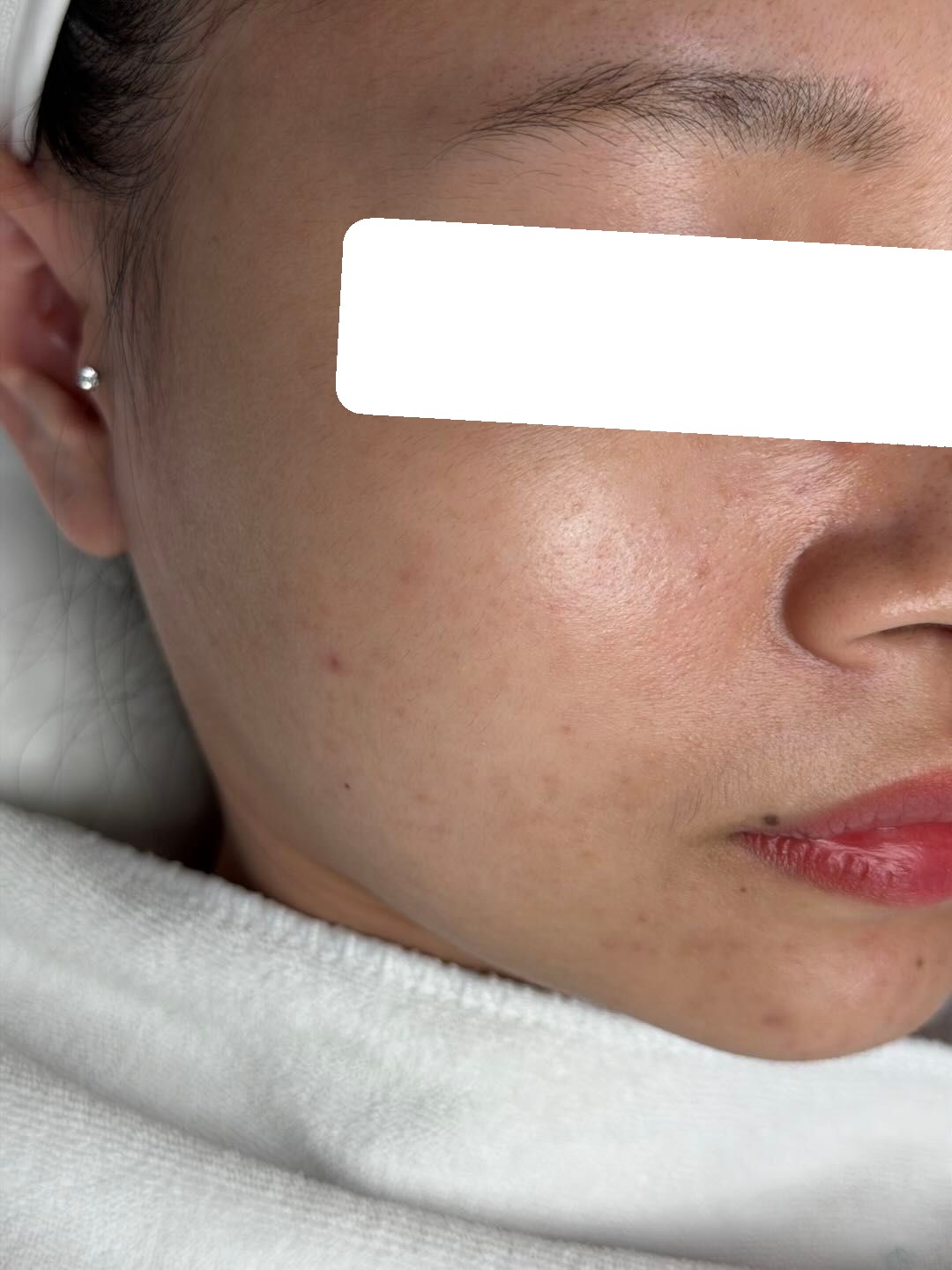 Inflamed acne, PIH — After 3 sessions