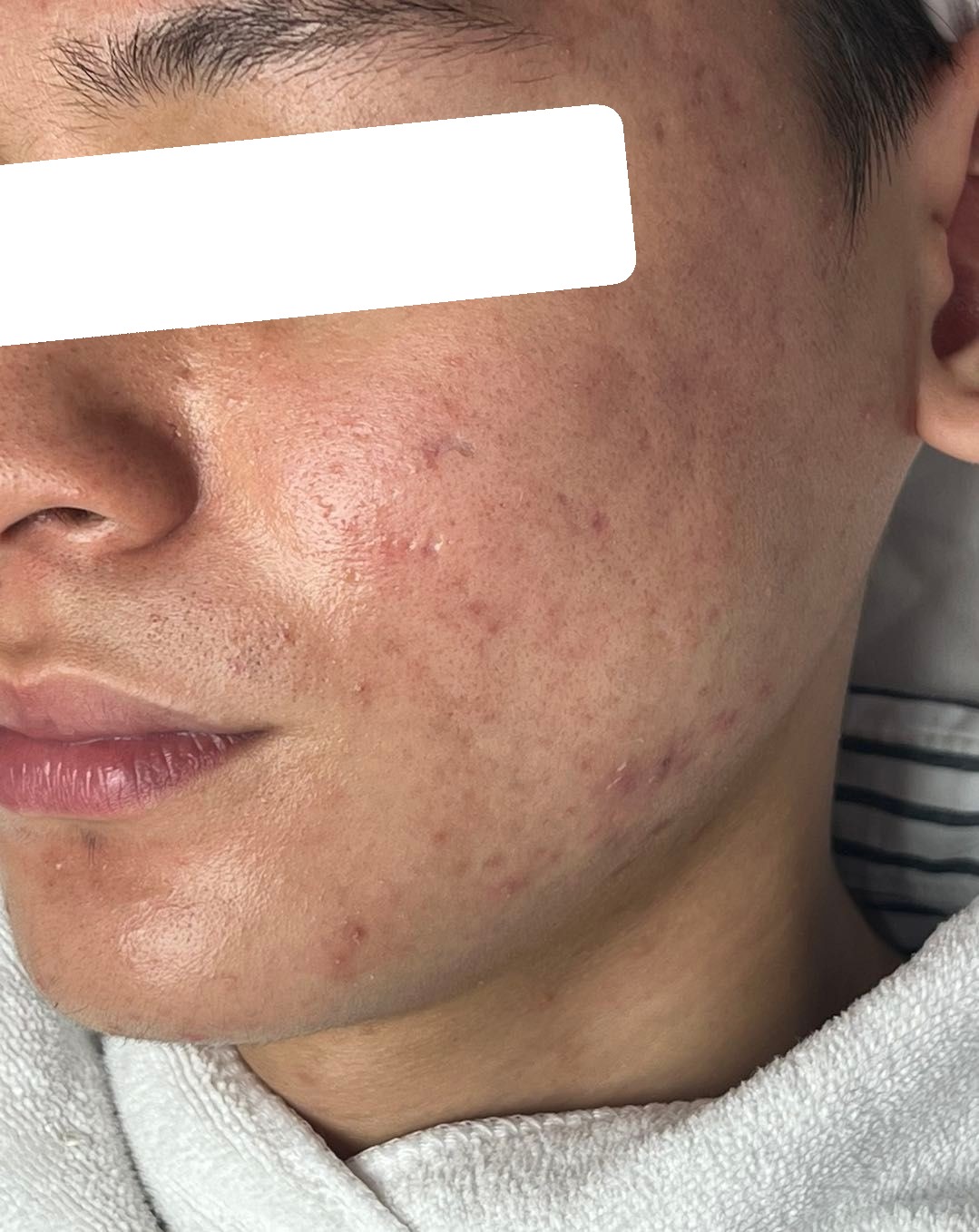 Inflamed and congested acne, PIE — After 5 sessions
