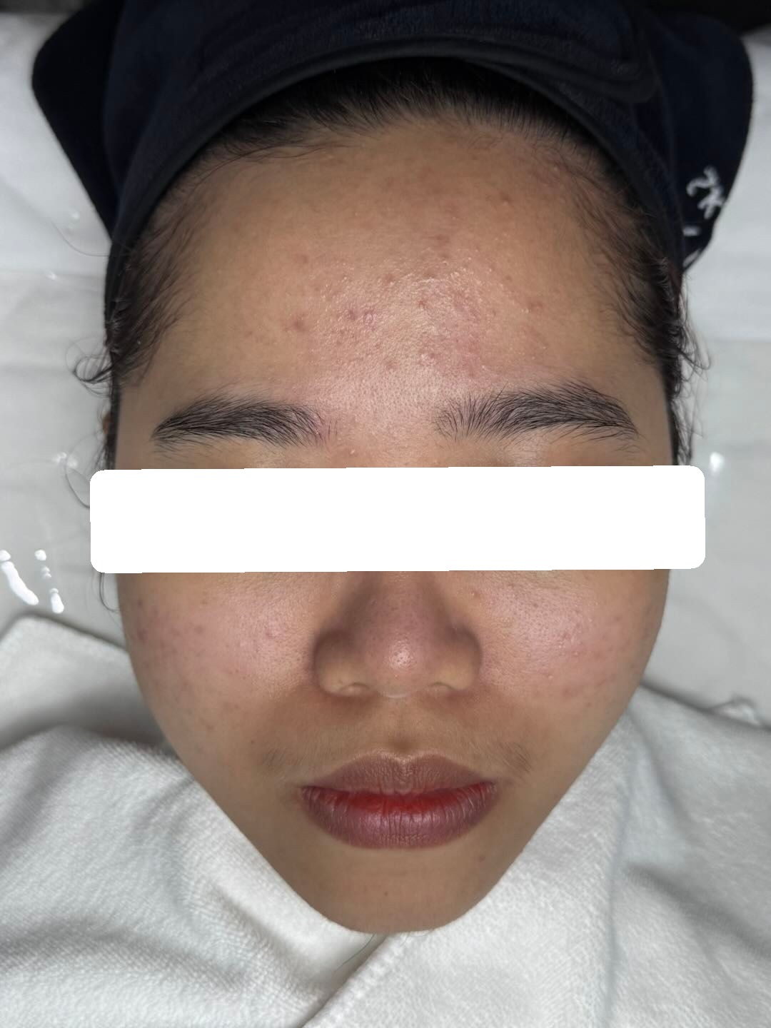 Inflamed and congested acne, PIH — After 1 session