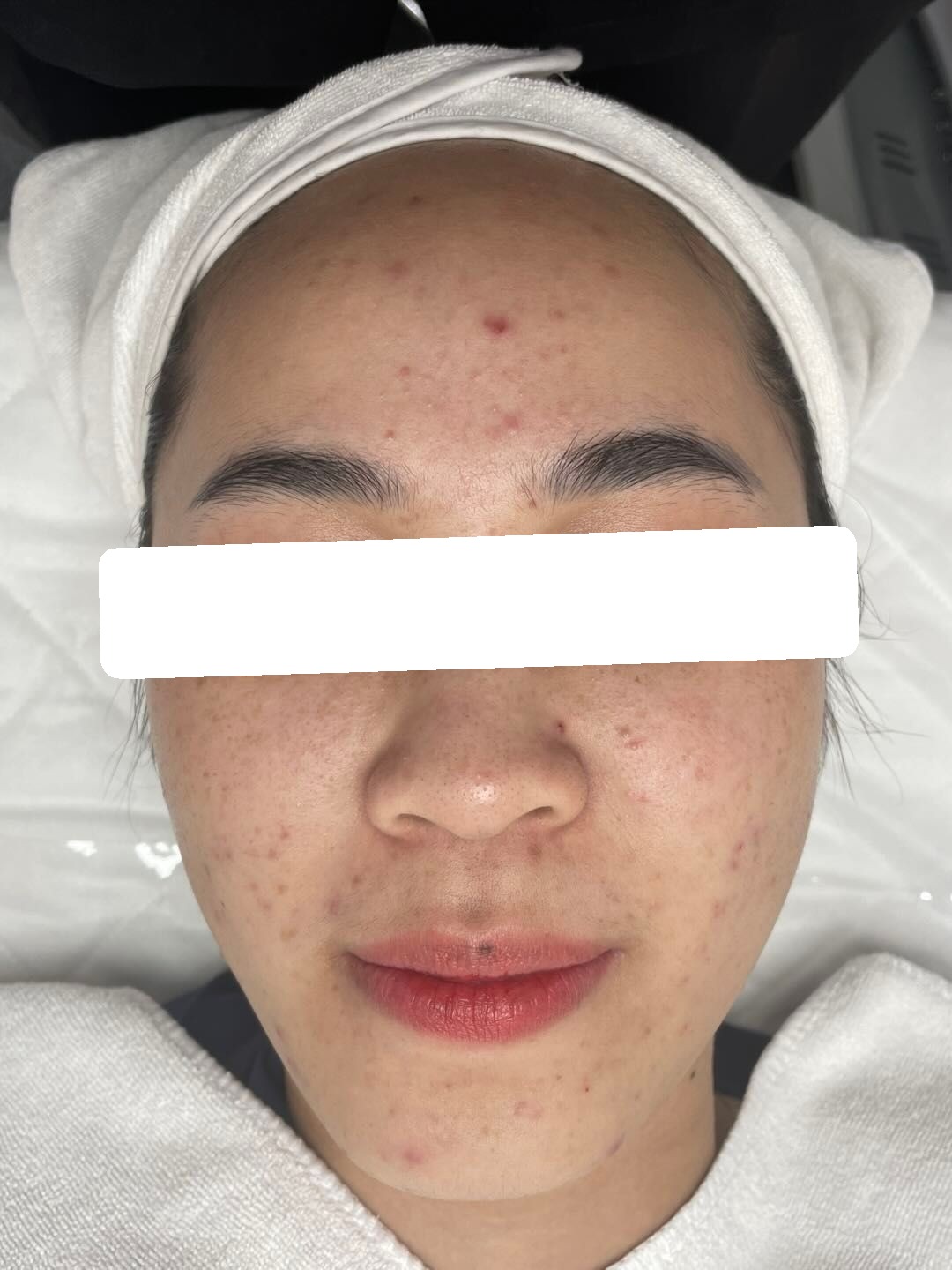 Inflamed and congested acne — Before