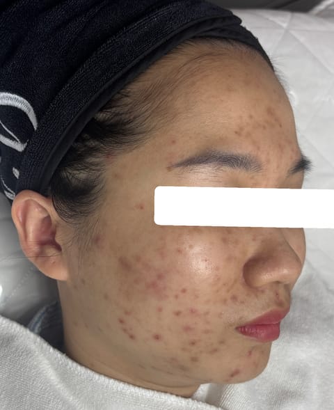Mụn ẩn bít tắc, PIH — Trước