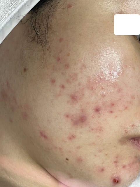 Mụn viêm nặng 2 vùng má — Trước