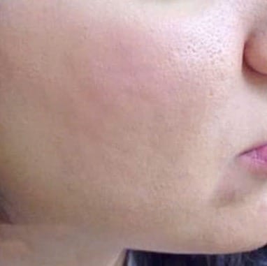 Sẹo rỗ nặng khắp vùng má, da xỉn màu — sau điều trị