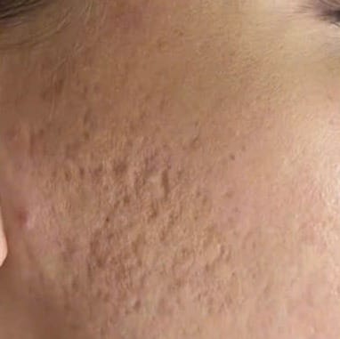 Sẹo rỗ sâu, bề mặt da sần sùi, lỗ chân lông giãn rộng — Trước
