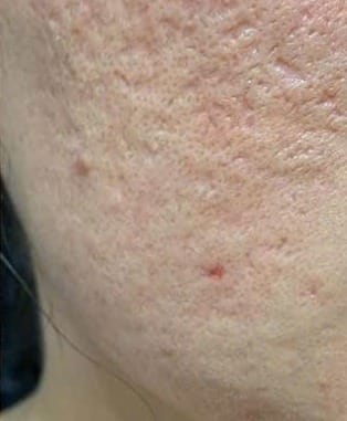Sẹo rỗ nặng, nhiều vết lõm sâu dày đặc vùng má, da sẹo đỏ — sau điều trị