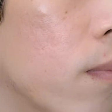 Sẹo rỗ sâu và dày đặc, bề mặt da sần sùi — sau điều trị