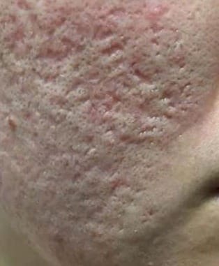 Sẹo rỗ nặng, nhiều vết lõm sâu dày đặc vùng má, da sẹo đỏ — Trước