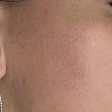 Sẹo rỗ sâu, bề mặt da sần sùi, lỗ chân lông giãn rộng — sau điều trị