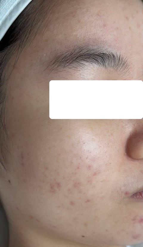 Mụn viêm nặng 2 vùng má — sau điều trị
