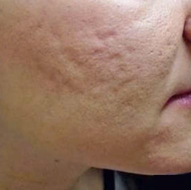 Sẹo rỗ nặng khắp vùng má, da xỉn màu — Trước