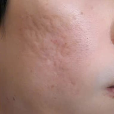 Sẹo rỗ sâu và dày đặc, bề mặt da sần sùi — Trước
