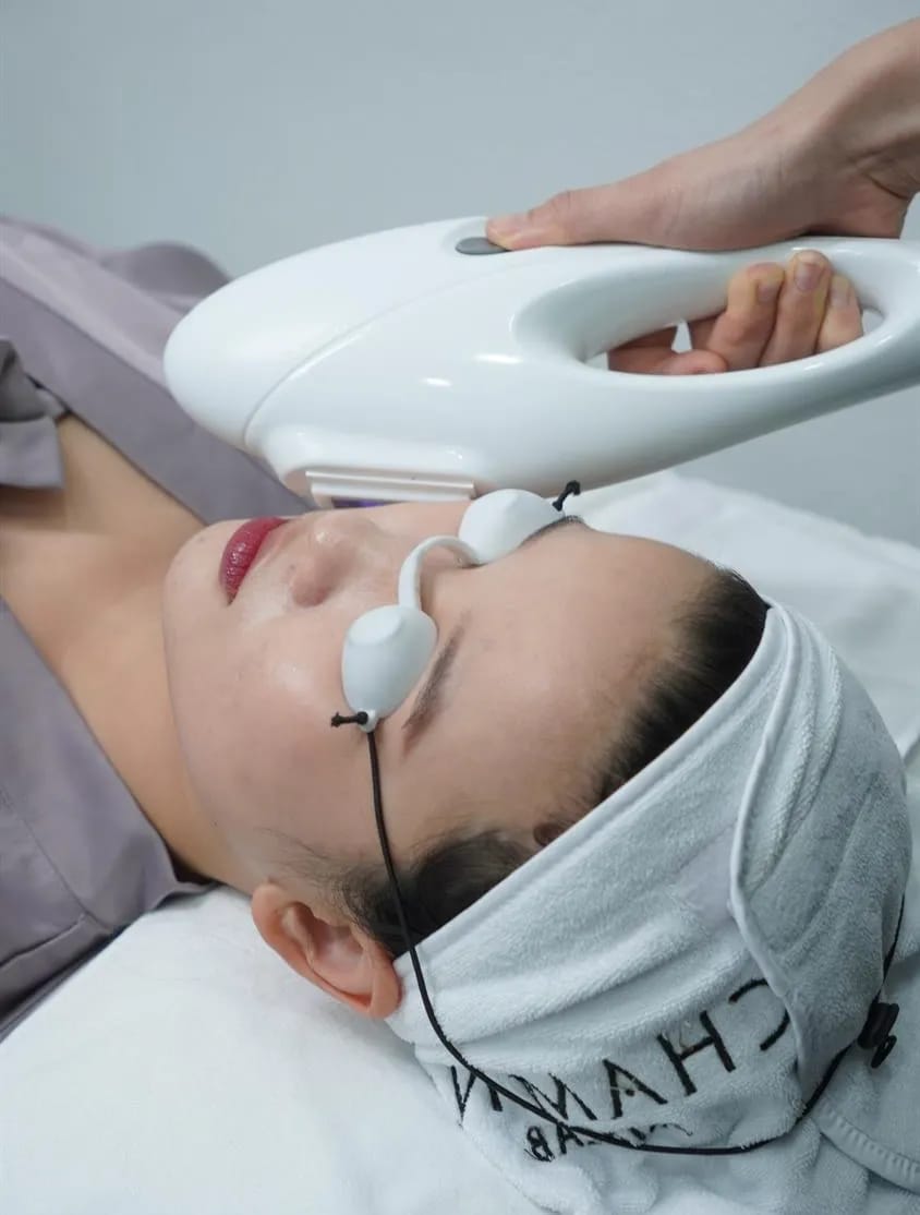 Triệt Lông Vùng Mép