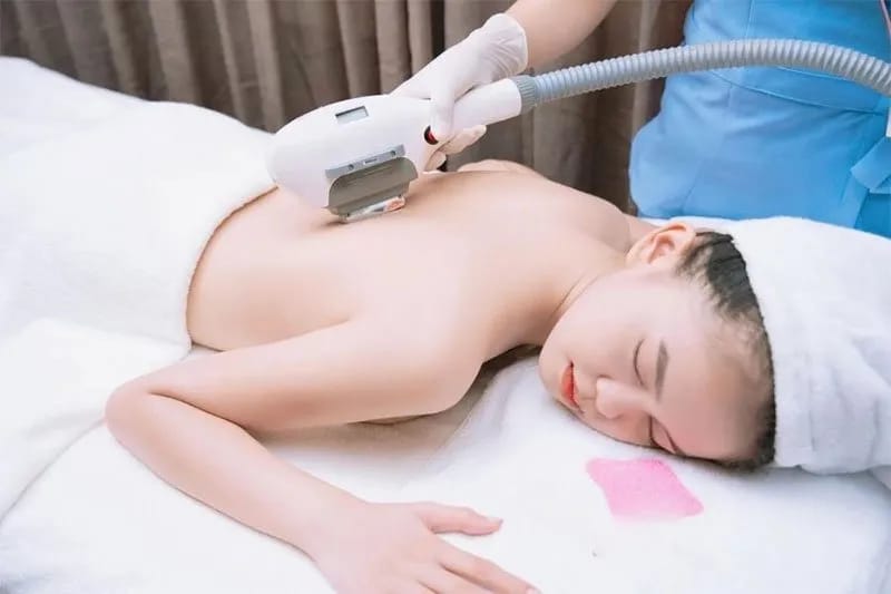 Triệt lông vùng lưng